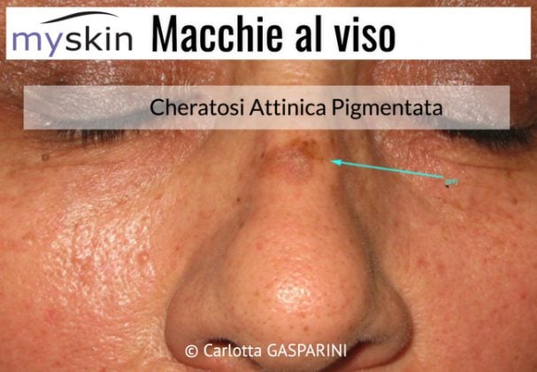 Macchie Al Viso Quali E Cosa Sono Myskin Dermatologi Online