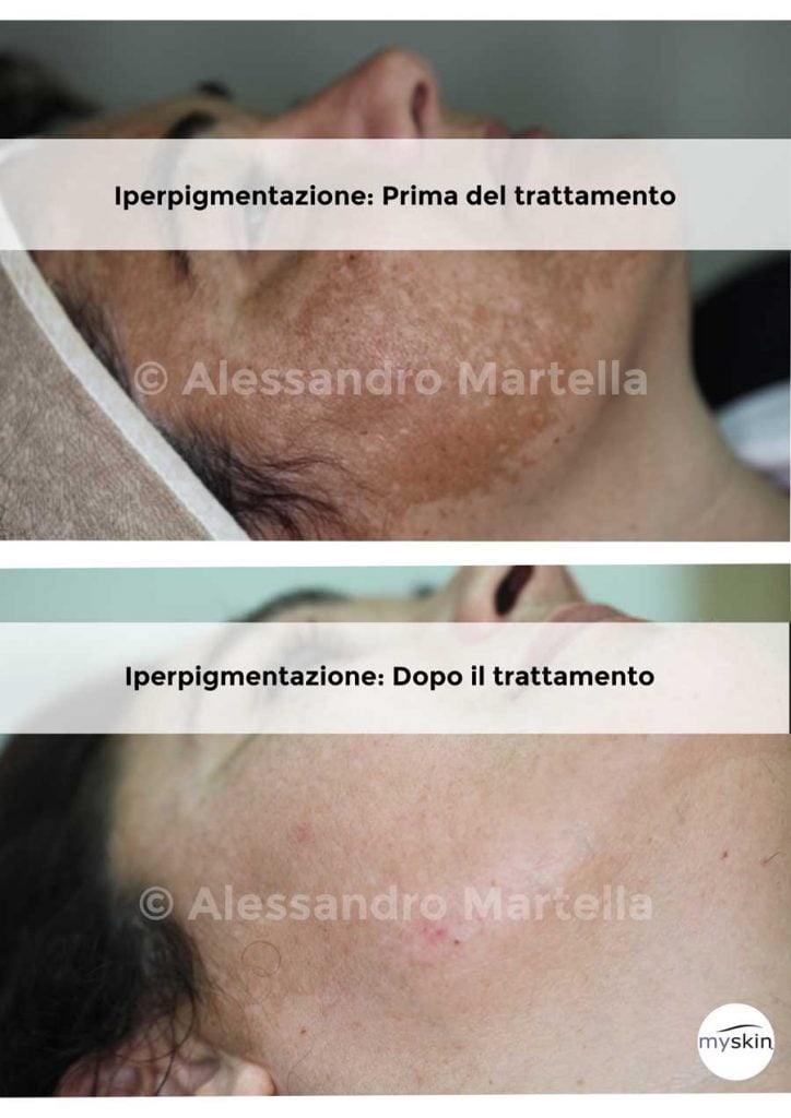 Iperpigmentazione Macchie Scure Sulla Pelle Quali Sono I Rimedi Myskin